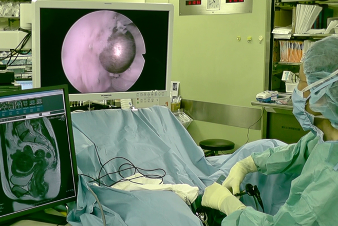 子宮筋腫摘出子宮鏡手術の写真