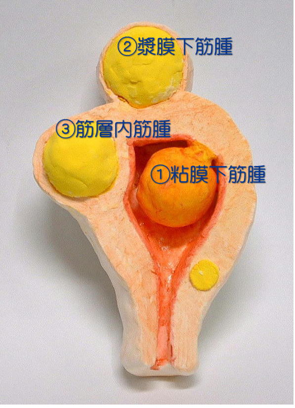 子宮筋腫の種類　粘膜下筋腫，筋層内筋腫，漿膜下筋腫